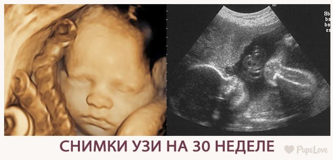 Снимки УЗИ на 30 неделе беременности